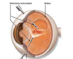 Vitrectomy